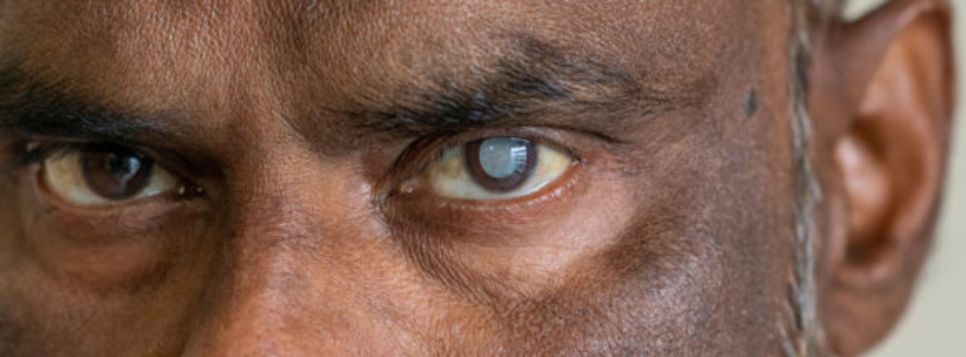 A male person with Cataract on his left eye. The eye has become whiter in the Centre