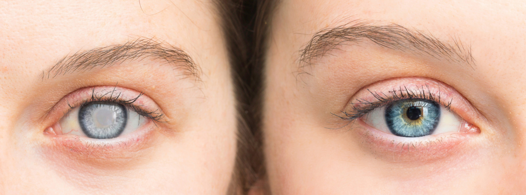 Person,With,White,Pupil,And,Healthy,Eye,Comparison,Close,Up